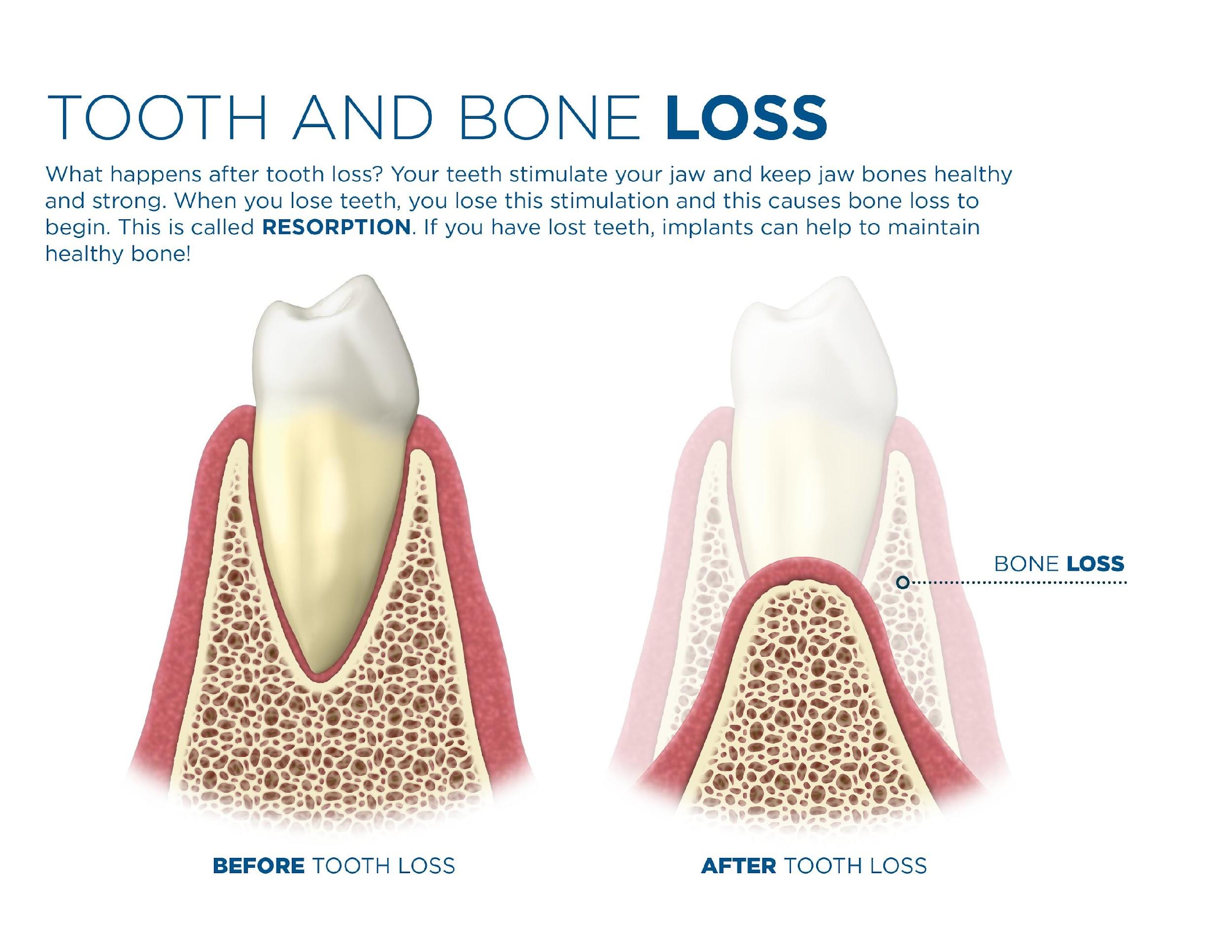 Tooth and bone loss cross-section: before tooth loss vs after tooth loss showing resorption