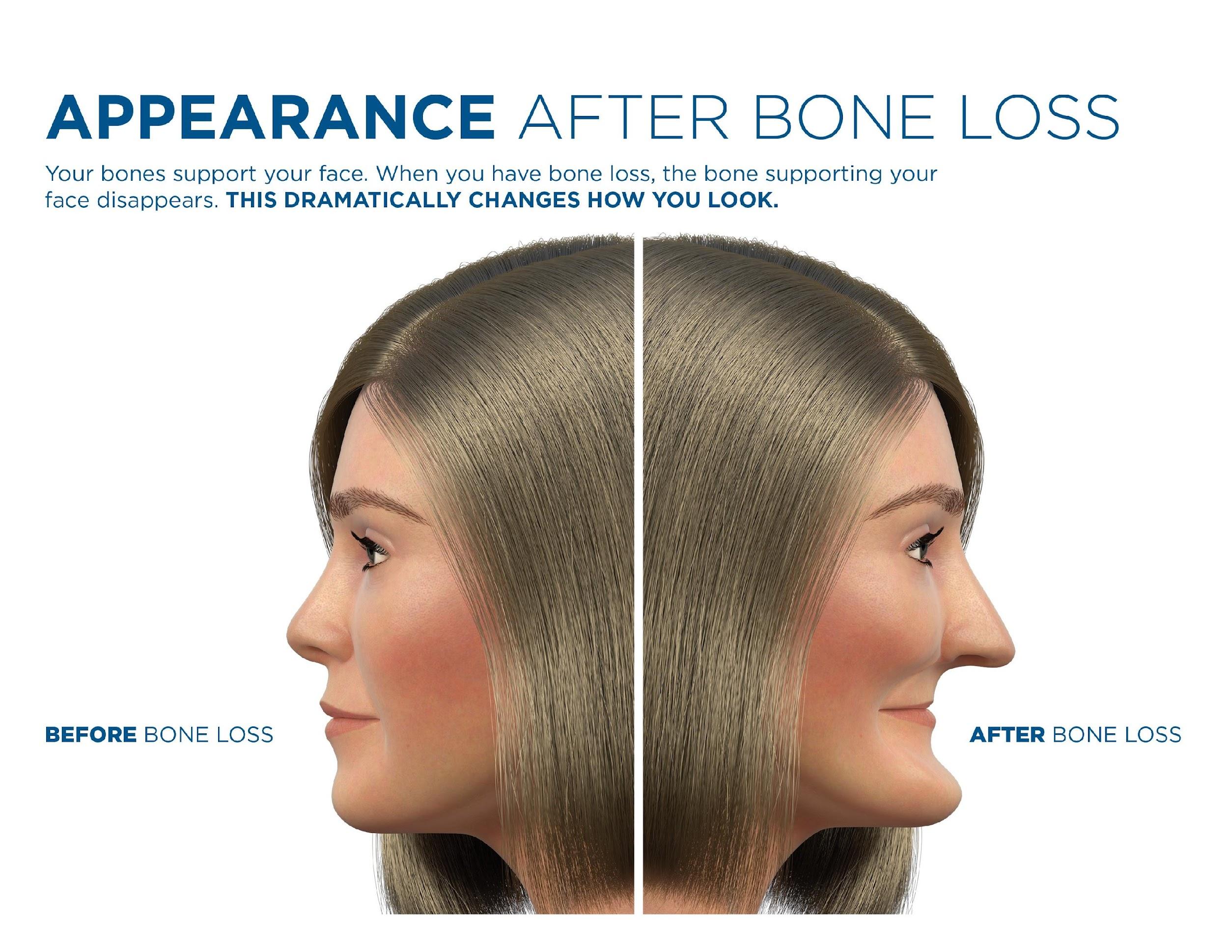 Facial profile comparison showing before and after bone loss from missing teeth