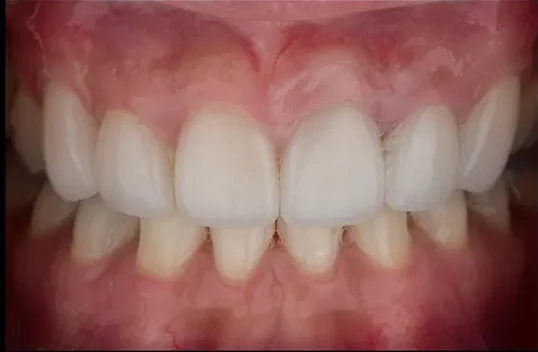 Advanced Porcelain Veneers — after
