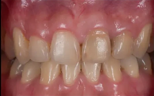 Advanced Porcelain Veneers — before