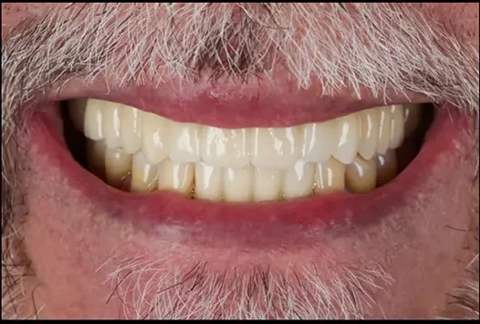 Recubrimiento Estético de Sonrisa — after
