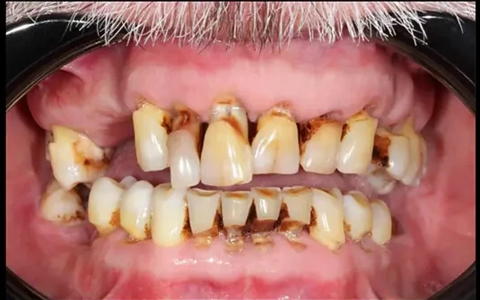 Recubrimiento Estético de Sonrisa — before