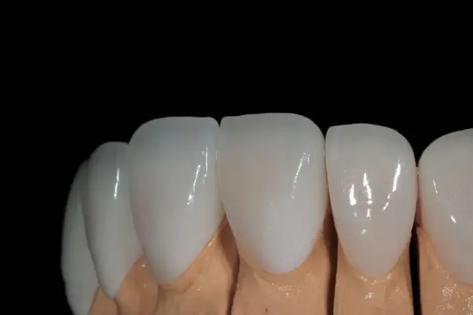 Dental prosthesis made with support from the in-house lab