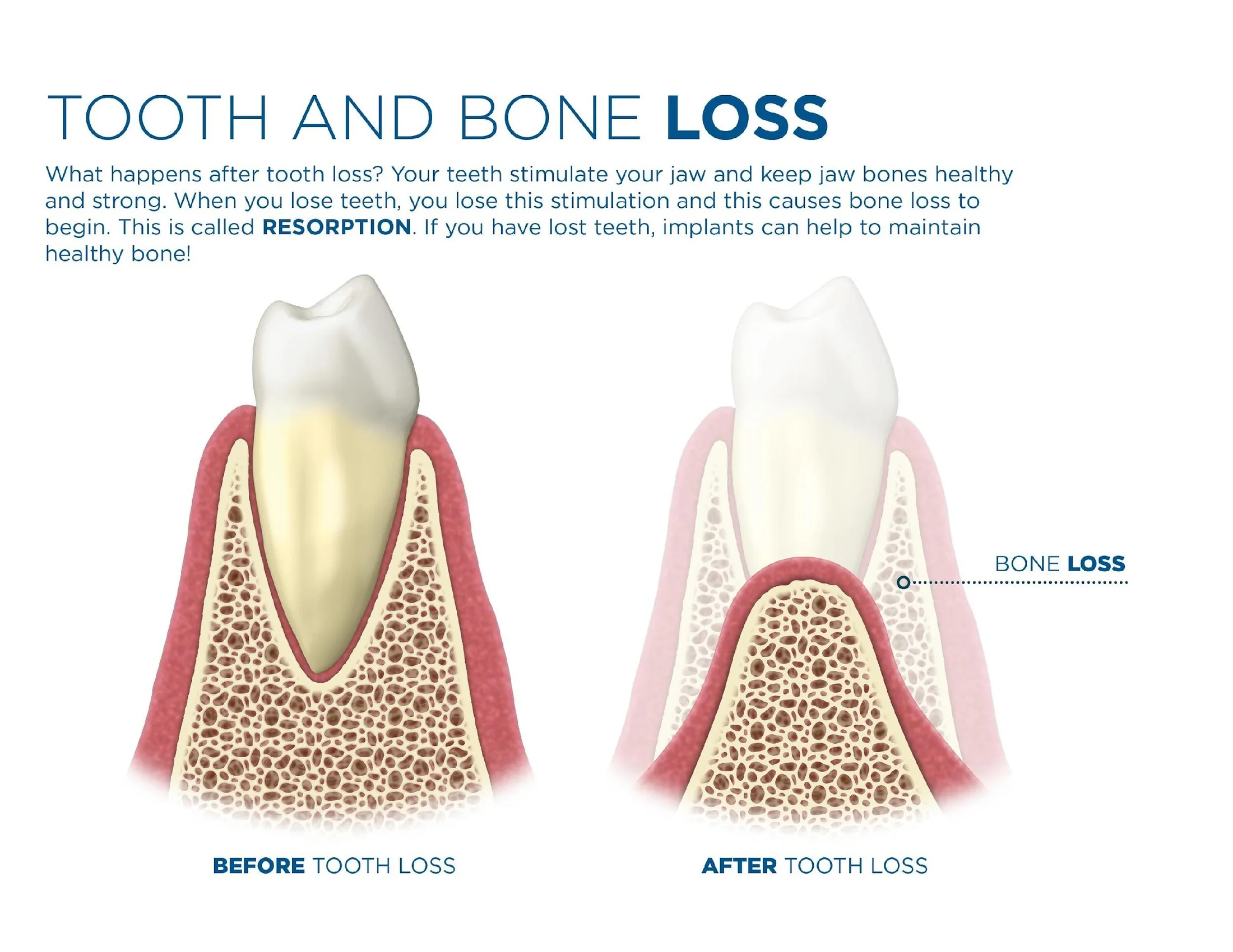 Dental Implants and Jawbone Loss: What the Evidence Shows