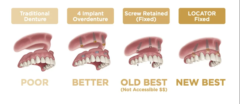 Comparison of Traditional Denture, 4-Implant Overdenture, Screw-Retained Fixed, and LOCATOR FIXED tiers
