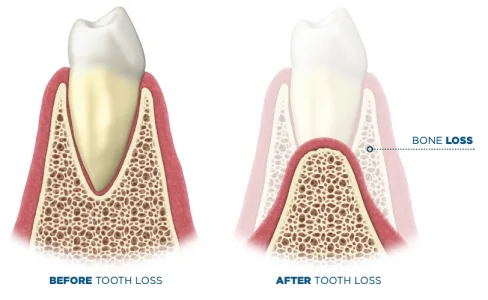 Resorción del hueso mandibular después de la pérdida de dientes