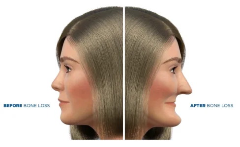 Cómo la pérdida ósea cambia la apariencia facial con el tiempo
